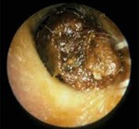 Wax in Ear Canal