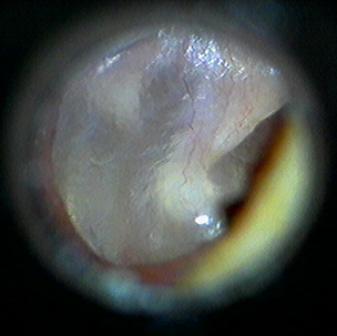 Normal Eardrum